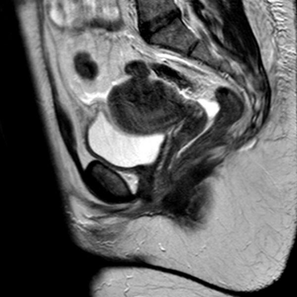 File:Adenomyoma of the uterus (Radiopaedia 9871-10439 Sagittal T2 15).jpg