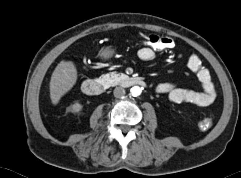 File:Adenomyomatosis of the gallbladder (Radiopaedia 12142-12483 Axial C+ arterial phase 23).jpg