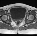 Adenomyosis - ovarian endometriomas (Radiopaedia 67031-76350 Axial T1 21).jpg