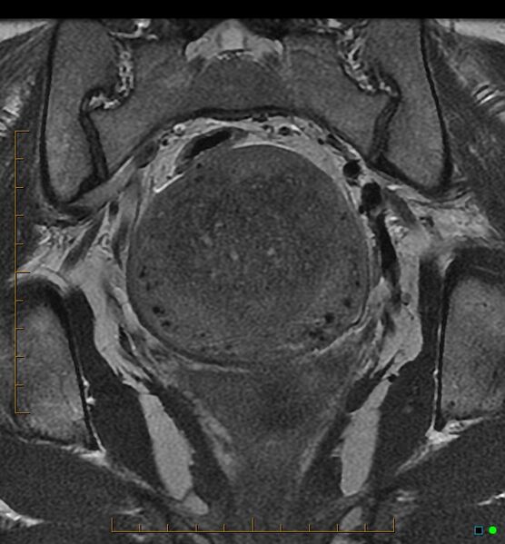 File:Adenomyosis uterus with hematometra (Radiopaedia 45779-50011 Coronal T2 15).jpg