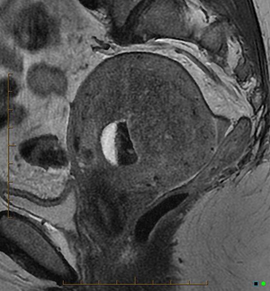 File:Adenomyosis uterus with hematometra (Radiopaedia 45779-50011 Sagittal T2 18).jpg