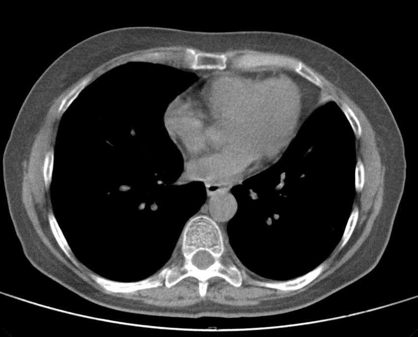 Adenosquamous lung carcinoma (Radiopaedia 22035-22030 non-contrast 38).jpg