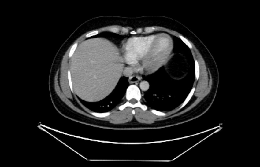 Adrenocortical carcinoma (Radiopaedia 80134-93438 Axial C+ portal venous phase 16).jpg