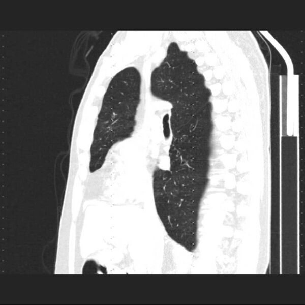 File:Allergic bronchopulmonary aspergillosis (Radiopaedia 21386-21320 Sagittal lung window 11).jpg