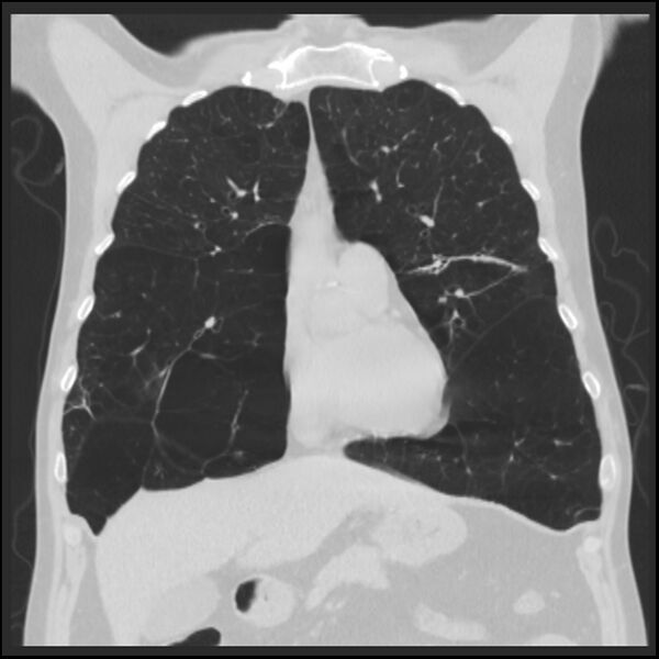 File:Alpha-1-antitrypsin deficiency (Radiopaedia 40993-43722 Coronal lung window 32).jpg