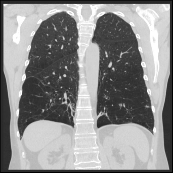 File:Alpha-1-antitrypsin deficiency (Radiopaedia 40993-43722 Coronal lung window 72).jpg