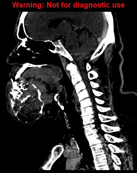 File:Ameloblastoma (Radiopaedia 33126-34164 F 38).jpg