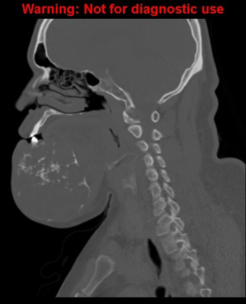 File:Ameloblastoma (Radiopaedia 33126-34164 Sagittal bone window 37).jpg