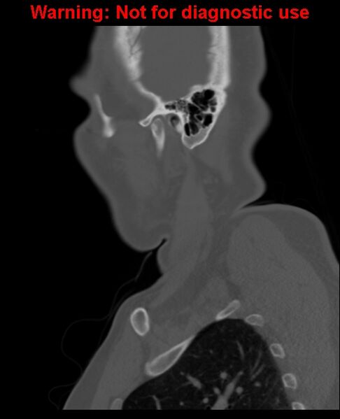 File:Ameloblastoma (Radiopaedia 33126-34164 Sagittal bone window 60).jpg