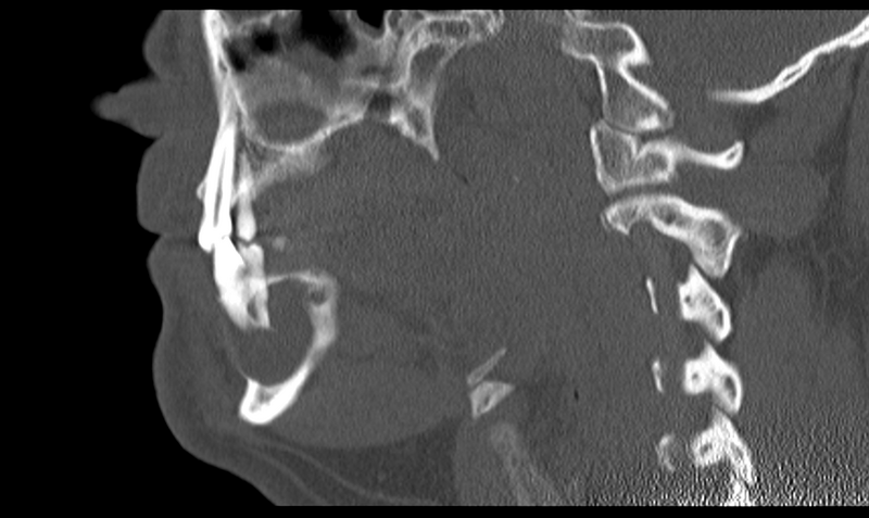File:Ameloblastoma (Radiopaedia 33677-34806 Sagittal bone window 28).png