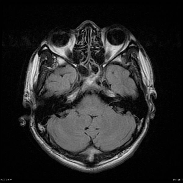 File:Amnestic syndrome secondary to hypoxic brain injury (Radiopaedia 24743-25004 FLAIR 5).jpg