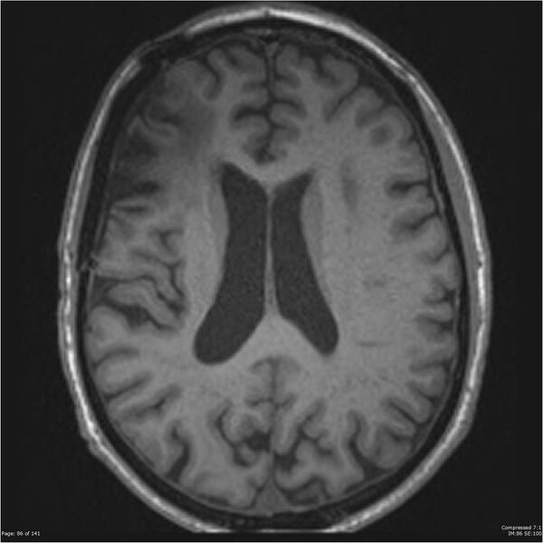 File:Anaplastic meningioma with recurrence (Radiopaedia 34452-35788 Axial T1 84).jpg