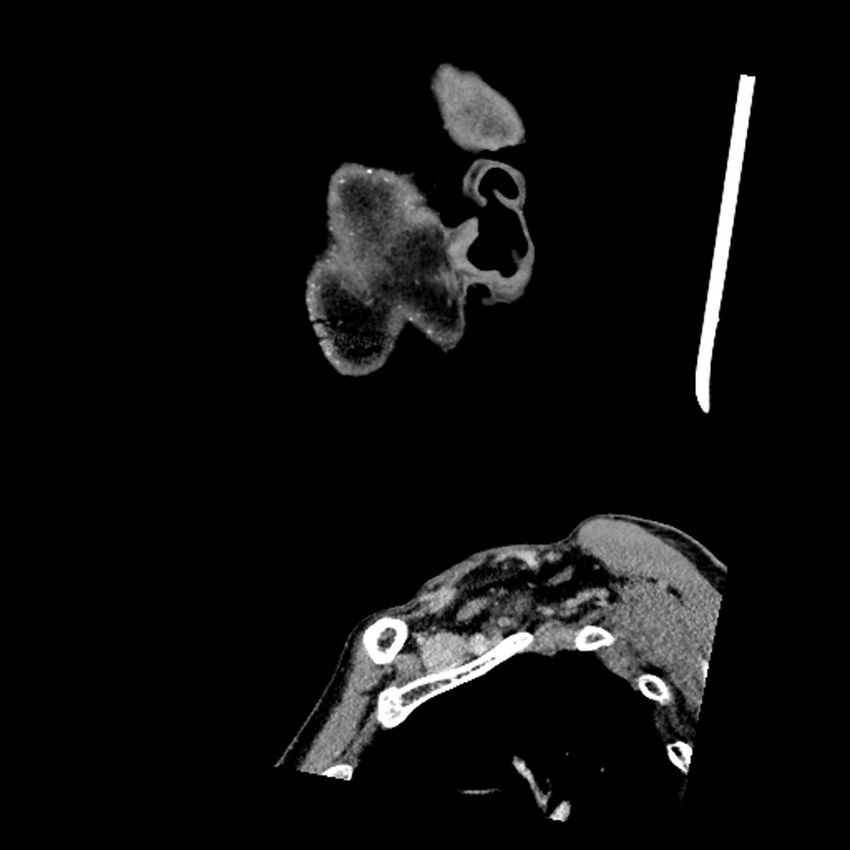 Anaplastic thyroid carcinoma (Radiopaedia 79087-92034 C 83).jpg