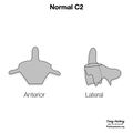 Anderson and D'Alonzo classification of C2 odontoid fractures (diagrams) (Radiopaedia 87249-103528 normal anatomy 1).jpeg
