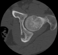 Aneurysmal bone cyst of ischium (Radiopaedia 25957-26094 B 16).png