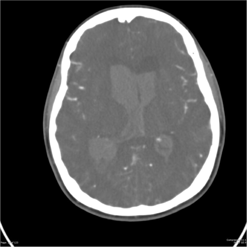 Aneurysmal subarachnoid hemorrhage and Moya Moya disease (Radiopaedia 34306-35593 Axial CT COW 27).jpg