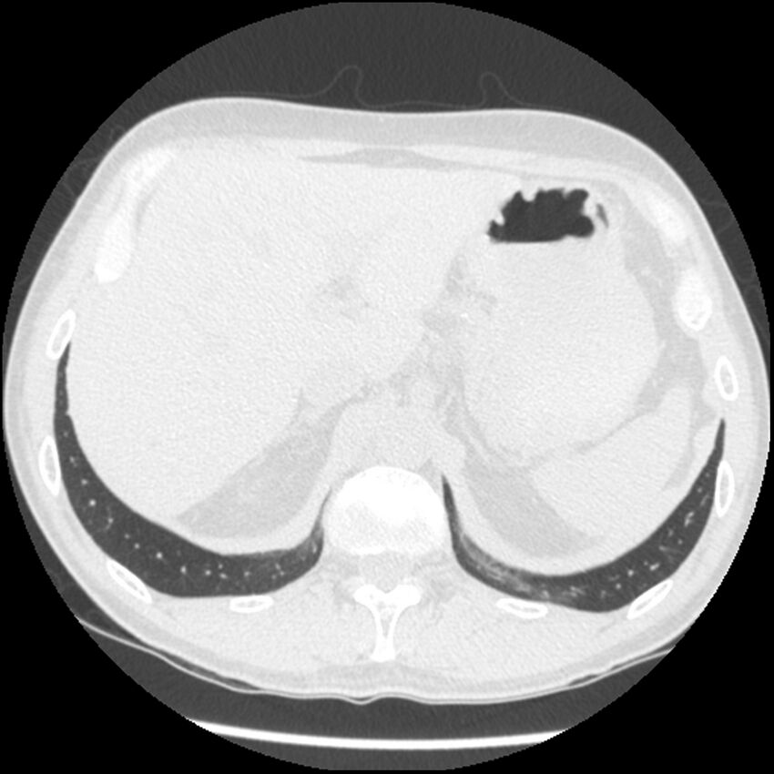 Angioinvasive aspergillosis (Radiopaedia 43957-47466 Axial lung window 65).jpg