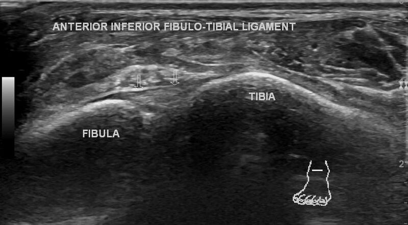 File:Anterior talofibular ligament injury (Radiopaedia 53338-59320 A 5).jpg