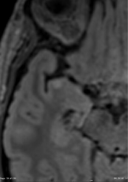 File:Anterior temporal lobe perivascular space (Radiopaedia 40946-43650 C 15).jpg