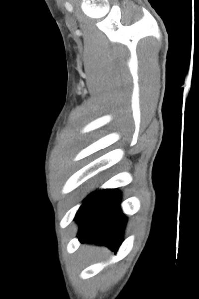 File:Aortic coarctation with aneurysm (Radiopaedia 74818-85828 B 17).jpg