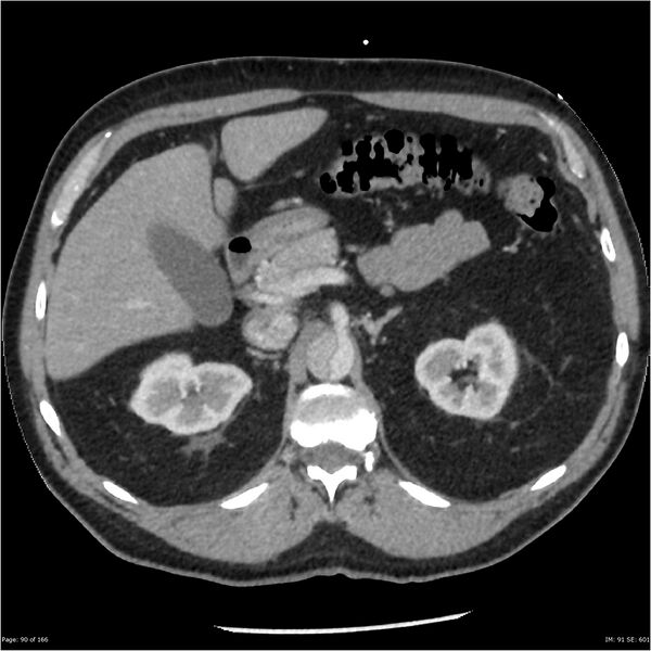 File:Aortic dissection- Stanford A (Radiopaedia 37759-39664 A 81).jpg