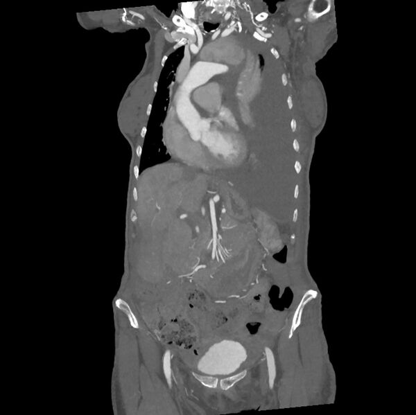File:Aortic dissection (Radiopaedia 68763-78691 B 11).jpeg