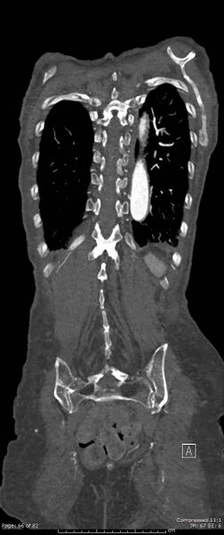 File:Aortic dissection with extension into aortic arch branches (Radiopaedia 64402-73204 A 66).jpg