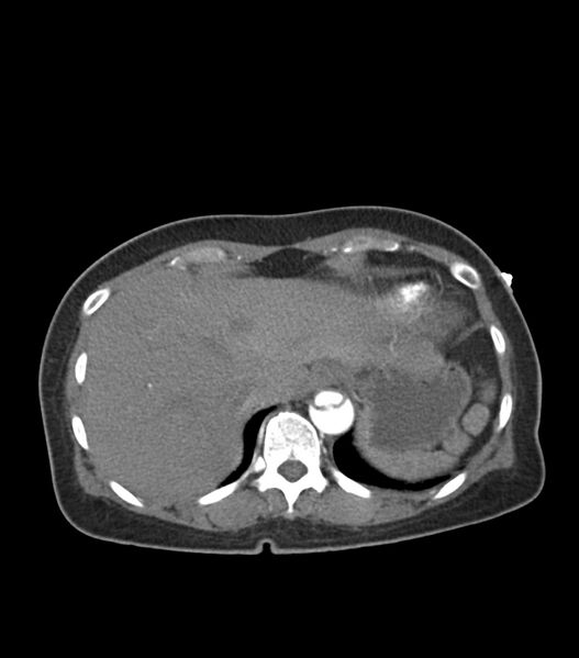 File:Aortic dissection with renal ischemia (Radiopaedia 76573-88338 A 55).jpg