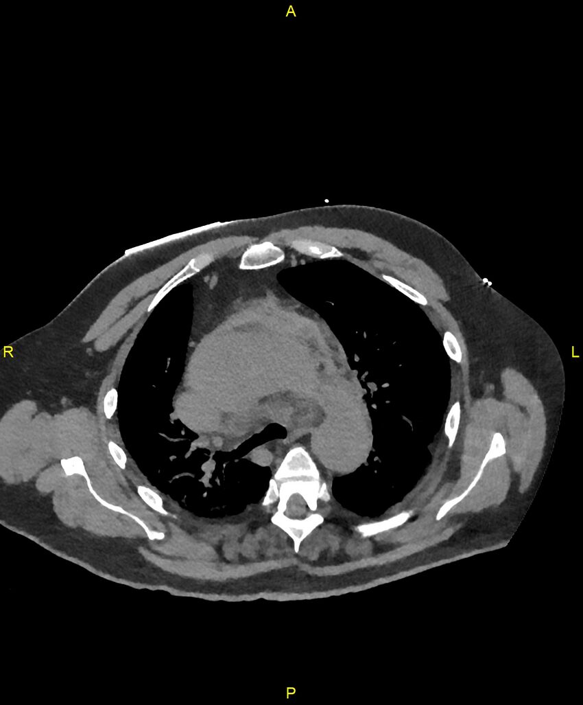 Aortic rupture (Radiopaedia 88822-105594 Axial non-contrast 71).jpg