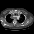 Aorto-coronary bypass graft aneurysms (Radiopaedia 40562-43157 A 26).png