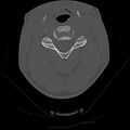 Apical pneumothorax on cervical spine CT (Radiopaedia 45343-49368 Axial bone window 37).jpg