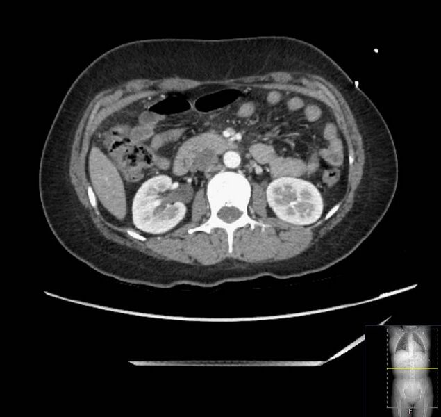 File:Appendicitis (CT angiogram) (Radiopaedia 154713-127660 Axial 107).jpg