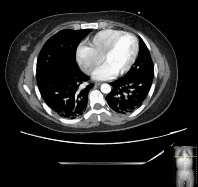 File:Appendicitis (CT angiogram) (Radiopaedia 154713-127660 Axial 187).jpg