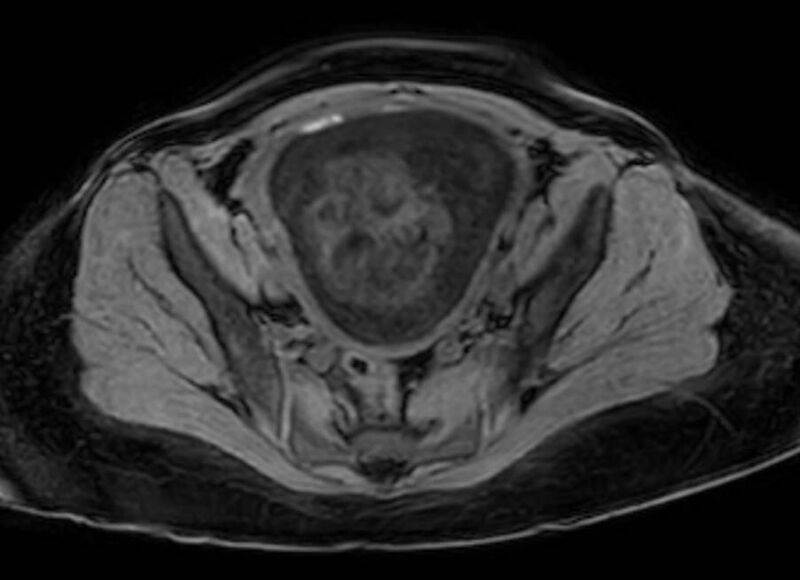 File:Appendicitis in gravida (MRI) (Radiopaedia 89433-106395 Axial DIXON 122).jpg