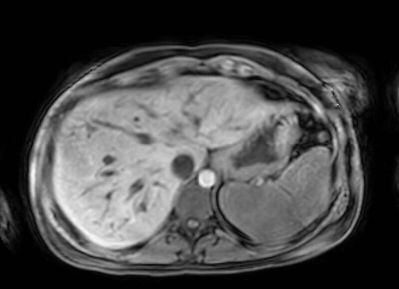 File:Appendicitis in gravida (MRI) (Radiopaedia 89433-106395 Axial DIXON 14).jpg