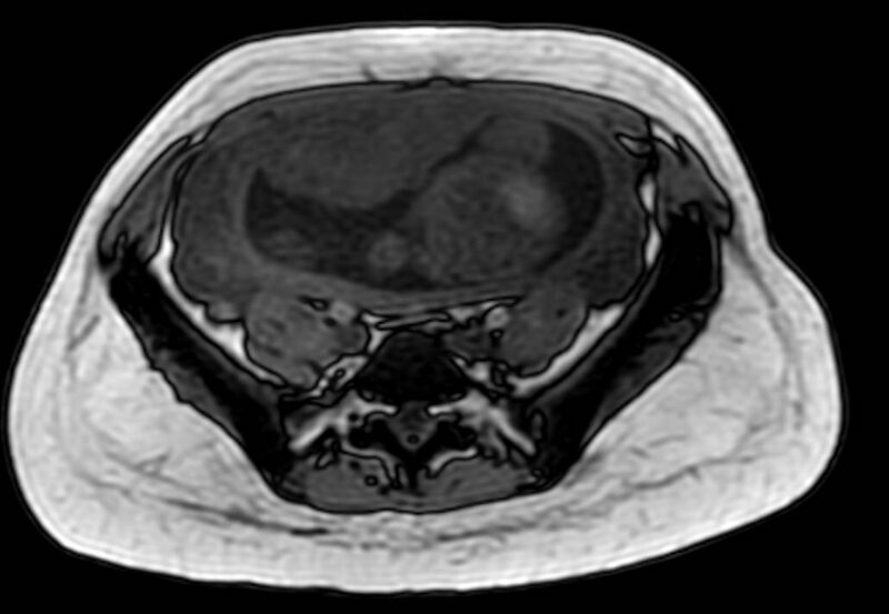 File:Appendicitis in gravida (MRI) (Radiopaedia 89433-106395 D 47).jpg