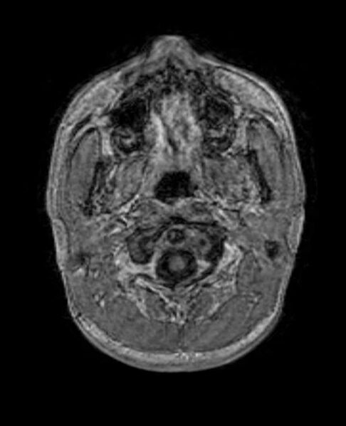 File:Arachnoid cyst- extremely large (Radiopaedia 68741-78451 Axial T1 C+ 5).jpg