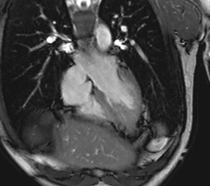 File:Arrhythmogenic right ventricular cardiomyopathy (Radiopaedia 39806-42237 D 124).jpg