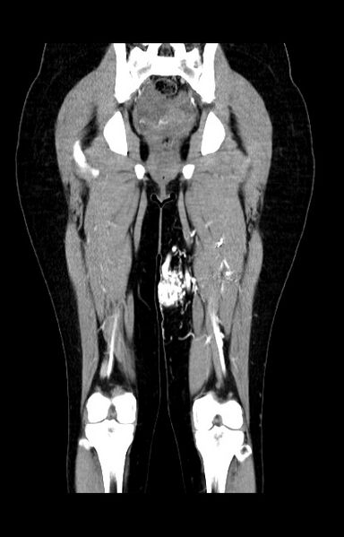 File:Arteriovenous malformation - thigh (Radiopaedia 14948-14883 None 5).jpg