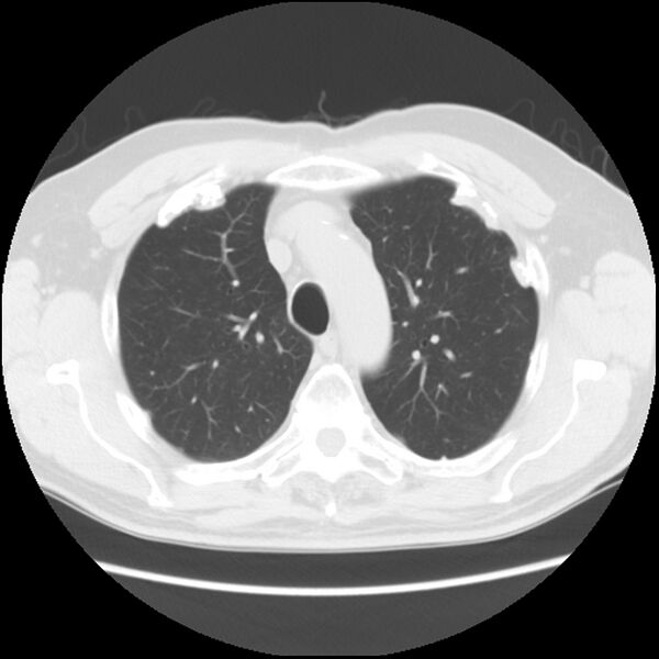 File:Asbestos-related pleural plaques (Radiopaedia 39069-41255 Axial lung window 19).jpg