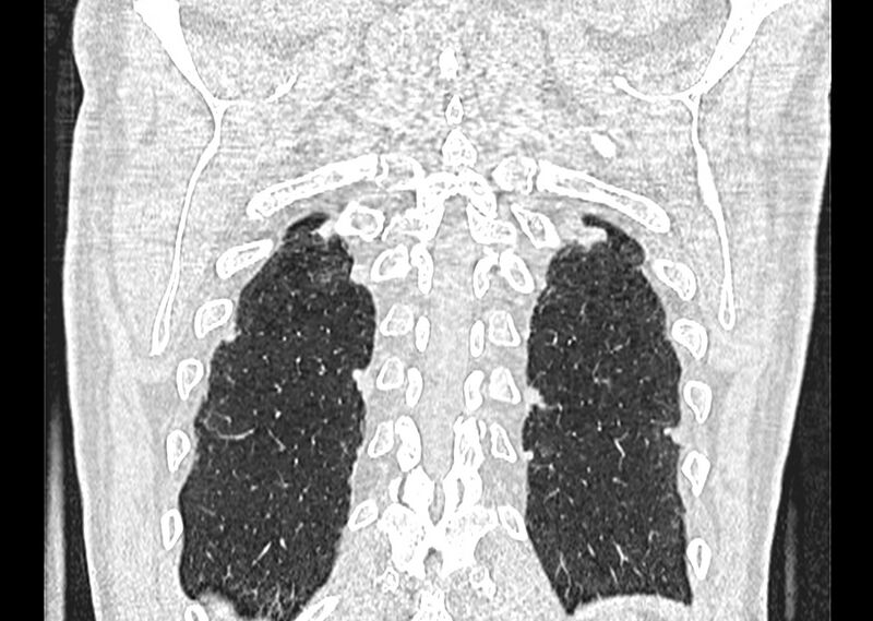 File:Asbestos pleural placques (Radiopaedia 57905-64872 Coronal lung window 258).jpg