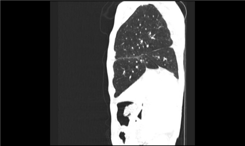 File:Aspergilloma (Radiopaedia 20788-20701 Sagittal lung window 16).jpg