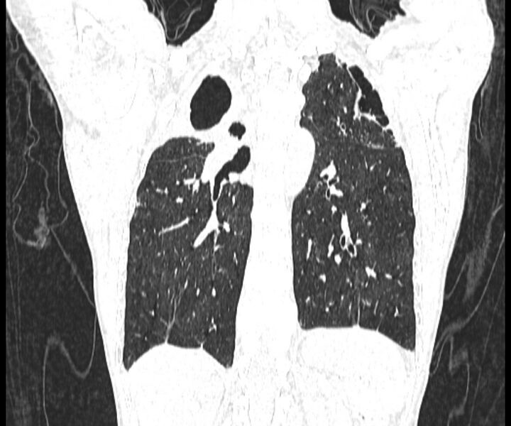 File:Aspergillomas (Radiopaedia 66779-76110 Coronal lung window 15).jpg