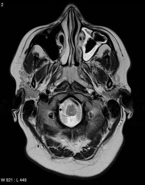 File:Astroblastoma (Radiopaedia 39792-42217 Axial T2 1).jpg