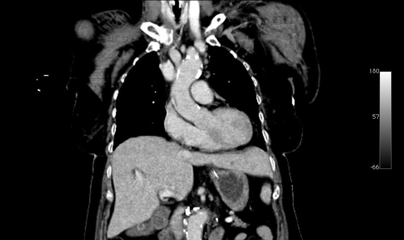 File:Atypical dissection of the thoracic aorta (Radiopaedia 10975-78320 B 9).jpg