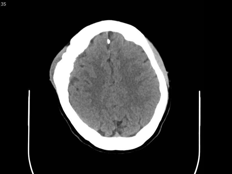 File:Atypical meningioma - intraosseous (Radiopaedia 64915-73867 A 35).jpg