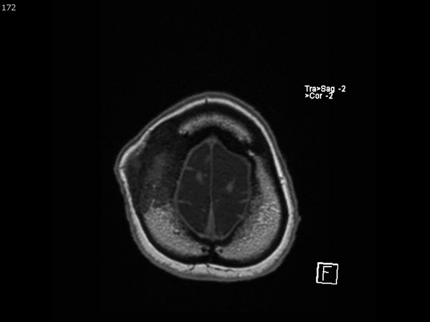 Atypical meningioma - intraosseous (Radiopaedia 64915-74572 Axial T1 172).jpg