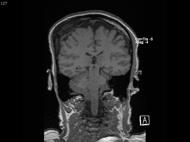 File:Atypical meningioma - intraosseous (Radiopaedia 64915-74572 Coronal T1 127).jpg