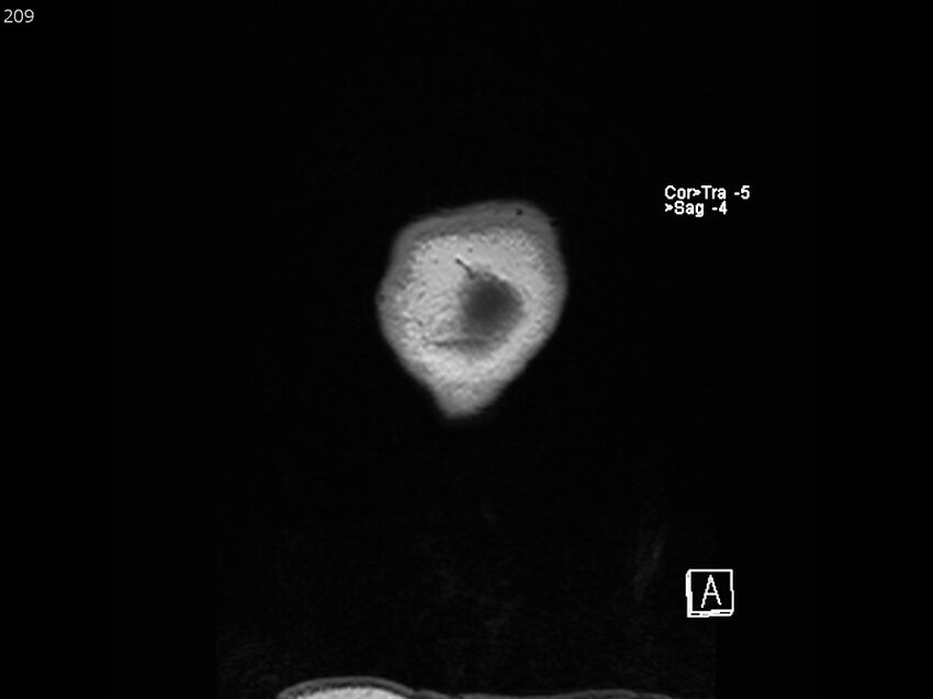 Atypical meningioma - intraosseous (Radiopaedia 64915-74572 Coronal T1 209).jpg