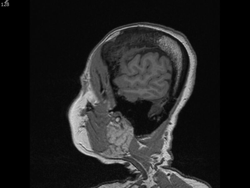 File:Atypical meningioma - intraosseous (Radiopaedia 64915-74572 Sagittal T1 128).jpg